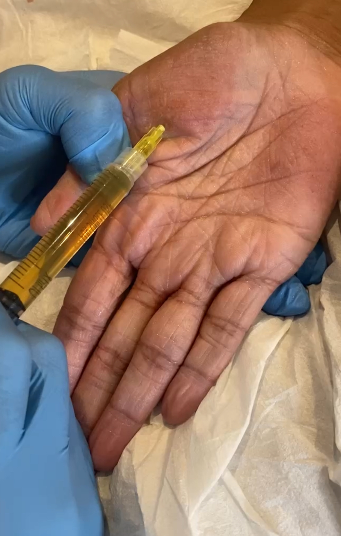 hand prp
