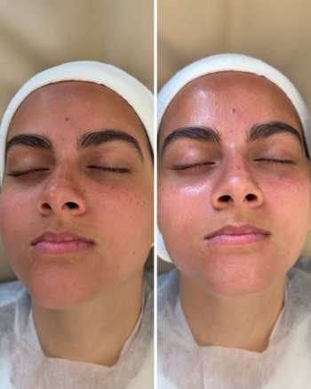 Retinol Facial - 5